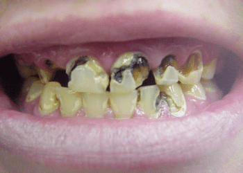 ThS. BS. Nguyễn Quang Tiến – GĐ Trung tâm CĐS Y tế Viện IMRIC; CEO BV RHM SG chia sẻ cách nhận biết sâu răng giai đoạn sớm