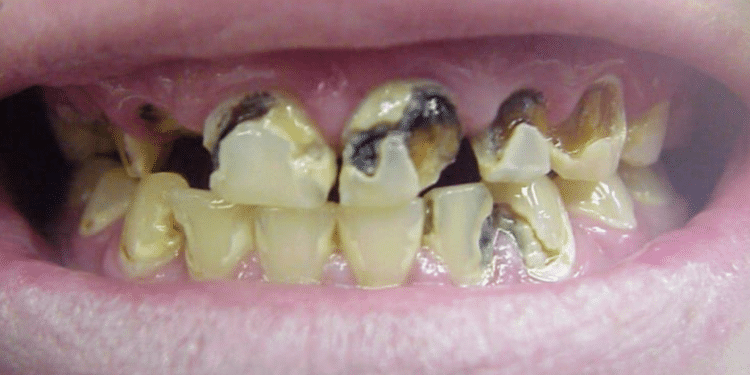 ThS. BS. Nguyễn Quang Tiến – GĐ Trung tâm CĐS Y tế Viện IMRIC; CEO BV RHM SG chia sẻ cách nhận biết sâu răng giai đoạn sớm